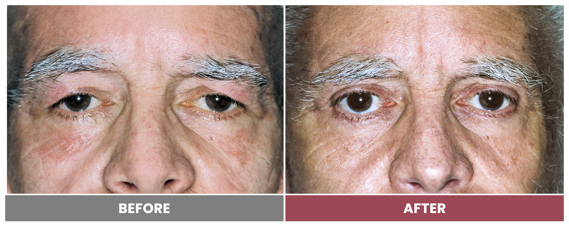 Upper Blepharoplasty - Case 95